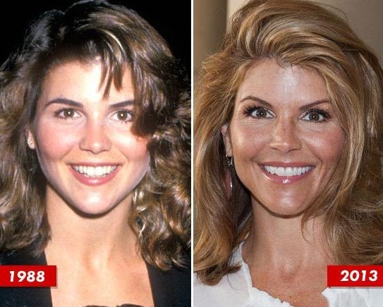 Lori Loughlin before and after plastic surgery