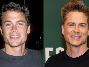 Rob Lowe before and after plastic surgery (19)