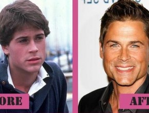 Rob Lowe before and after plastic surgery (27)
