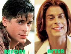 Rob Lowe before and after plastic surgery (31)