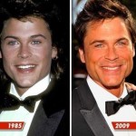 Rob Lowe plastic surgery (24)