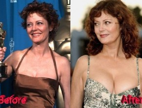 Susan Sarandon before and after plastic surgery