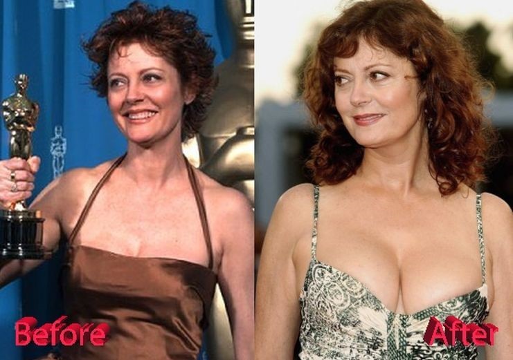 Susan Sarandon before and after plastic surgery