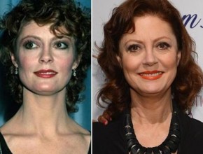 Susan Sarandon before and after plastic surgery (21)