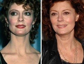 Susan Sarandon before and after plastic surgery (4)