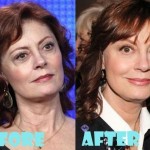 Susan Sarandon plastic surgery (18)