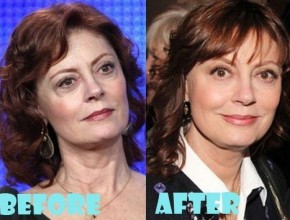 Susan Sarandon plastic surgery (18)