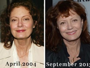 Susan Sarandon plastic surgery (19)