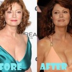 Susan Sarandon plastic surgery (23)