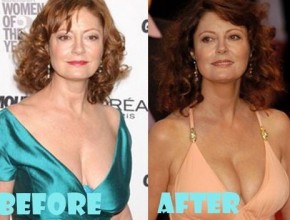 Susan Sarandon plastic surgery (23)