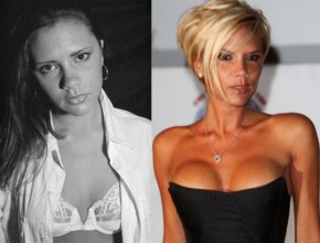 Victoria Beckham before and after breast augmentation (18)