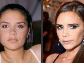 Victoria Beckham before and after facelift (8)