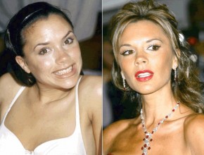 Victoria Beckham before and after plastic surgery (17)