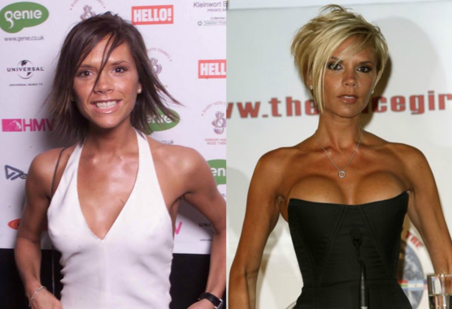 Victoria Beckham before and after plastic surgery