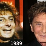 Barry Manilow before and after plastic surgery