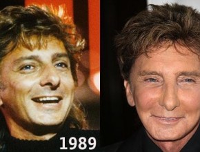 Barry Manilow before and after plastic surgery