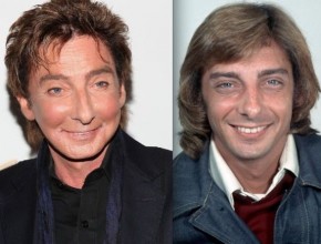 Barry Manilow before and after plastic surgery