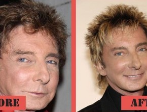 Barry Manilow before and after plastic surgery