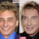 Barry Manilow before and after plastic surgery