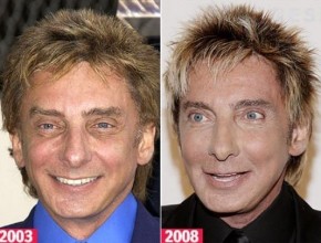 Barry Manilow before and after plastic surgery