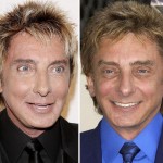 Barry Manilow before and after plastic surgery