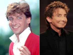 Barry Manilow before and after plastic surgery