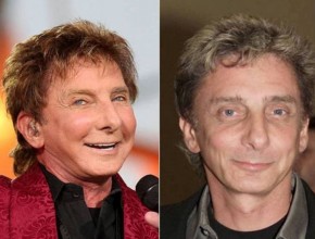 Barry Manilow before and after plastic surgery