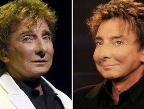 Barry Manilow before and after plastic surgery