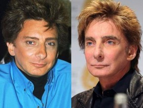 Barry Manilow before and after plastic surgery (5)