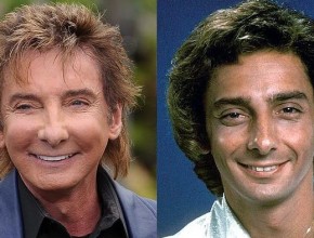 Barry Manilow before and after plastic surgery