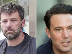 Ben Affleck before and after plastic surgery