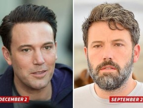 Ben Affleck before and after plastic surgery