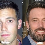 Ben Affleck before and after plastic surgery (20)