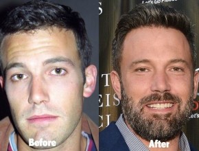 Ben Affleck before and after plastic surgery (20)