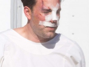 Ben Affleck plastic surgery (1)