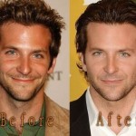 Bradley Cooper before and after plastic surgery