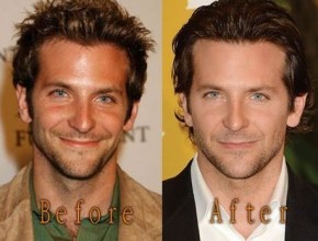 Bradley Cooper before and after plastic surgery