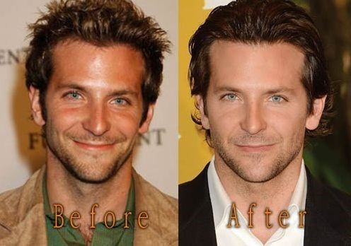 Bradley Cooper before and after plastic surgery