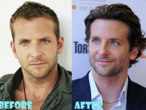 Bradley Cooper before and after plastic surgery (15)