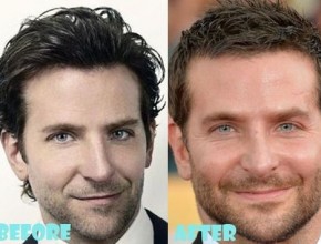 Bradley Cooper before and after plastic surgery (16)