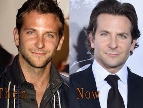 Bradley Cooper before and after plastic surgery (17)