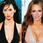 Jennifer Love Hewitt before and after plastic surgery (38)