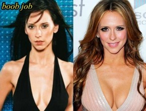 Jennifer Love Hewitt before and after plastic surgery (38)