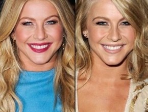 Julianne Hough before and after plastic surgery