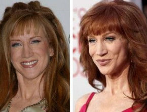 Kathy Griffin before and after plastic surgery (11)