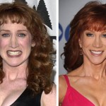 Kathy Griffin before and after plastic surgery (18)