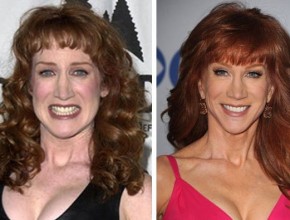 Kathy Griffin before and after plastic surgery (18)