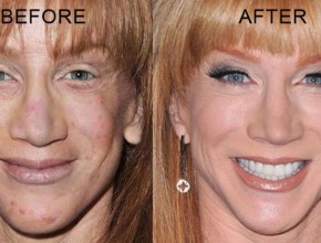 Kathy Griffin before and after plastic surgery (22)