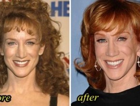 Kathy Griffin plastic surgery (20)