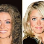 Kelly Ripa before and after plastic surgery (9)